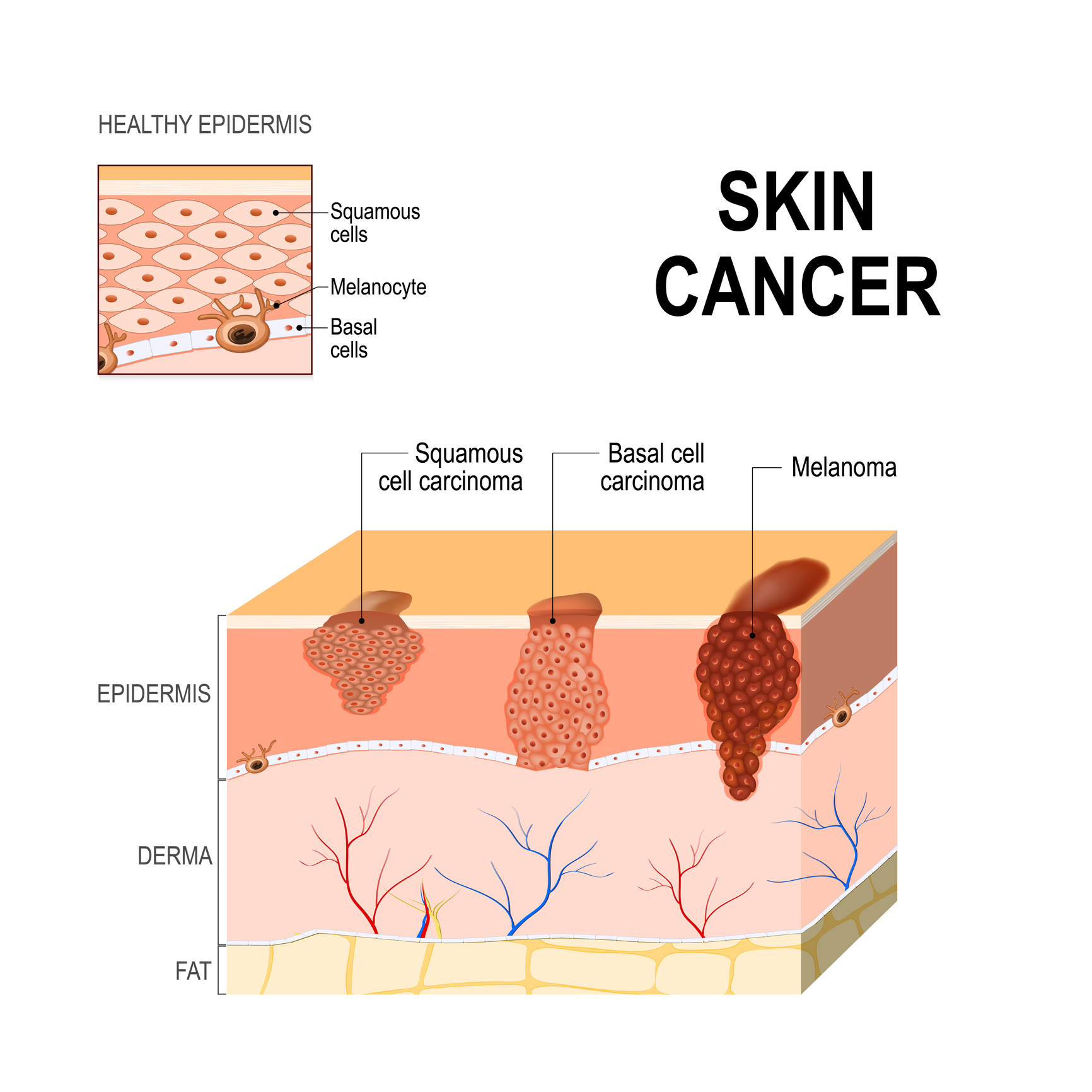 what causes skin cancer        <h3 class=