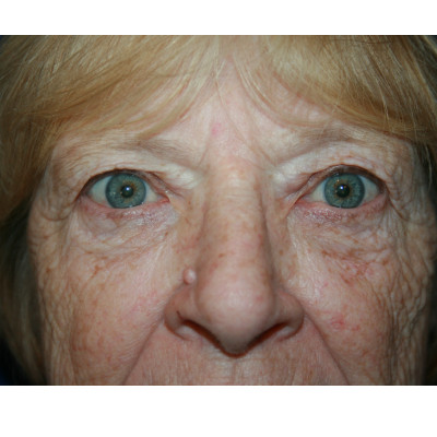Blepharoplasty
