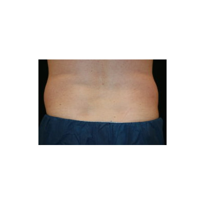 Coolsculpting Coolsculpting
