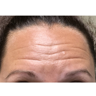 Botox