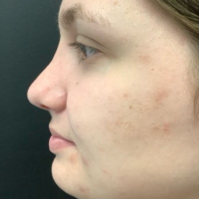 Rhinoplasty