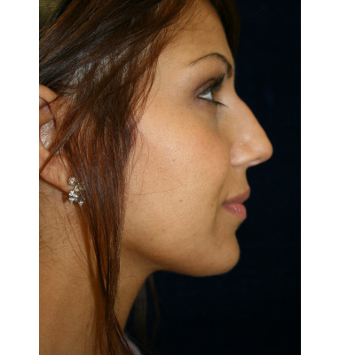 Rhinoplasty